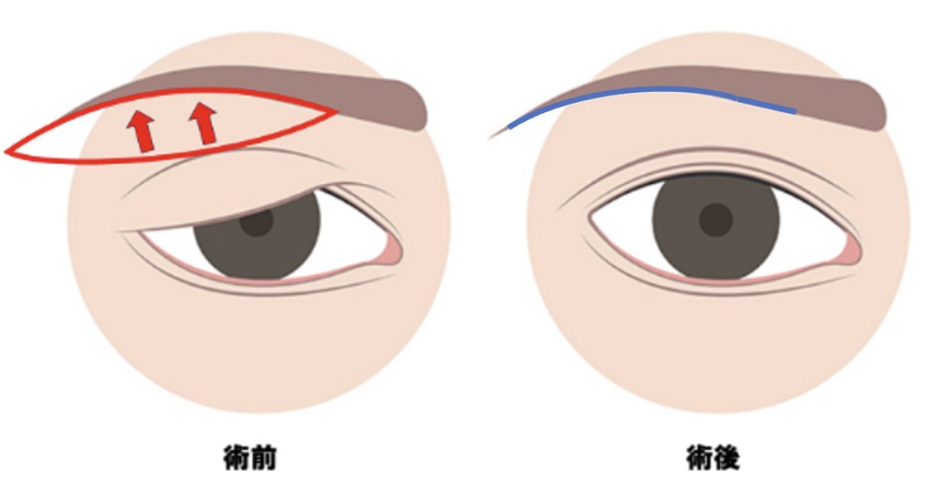 まぶたの疾患|柏市の形成外科・美容皮膚科|かしわ形成外科クリニック|眼瞼下垂・シミ